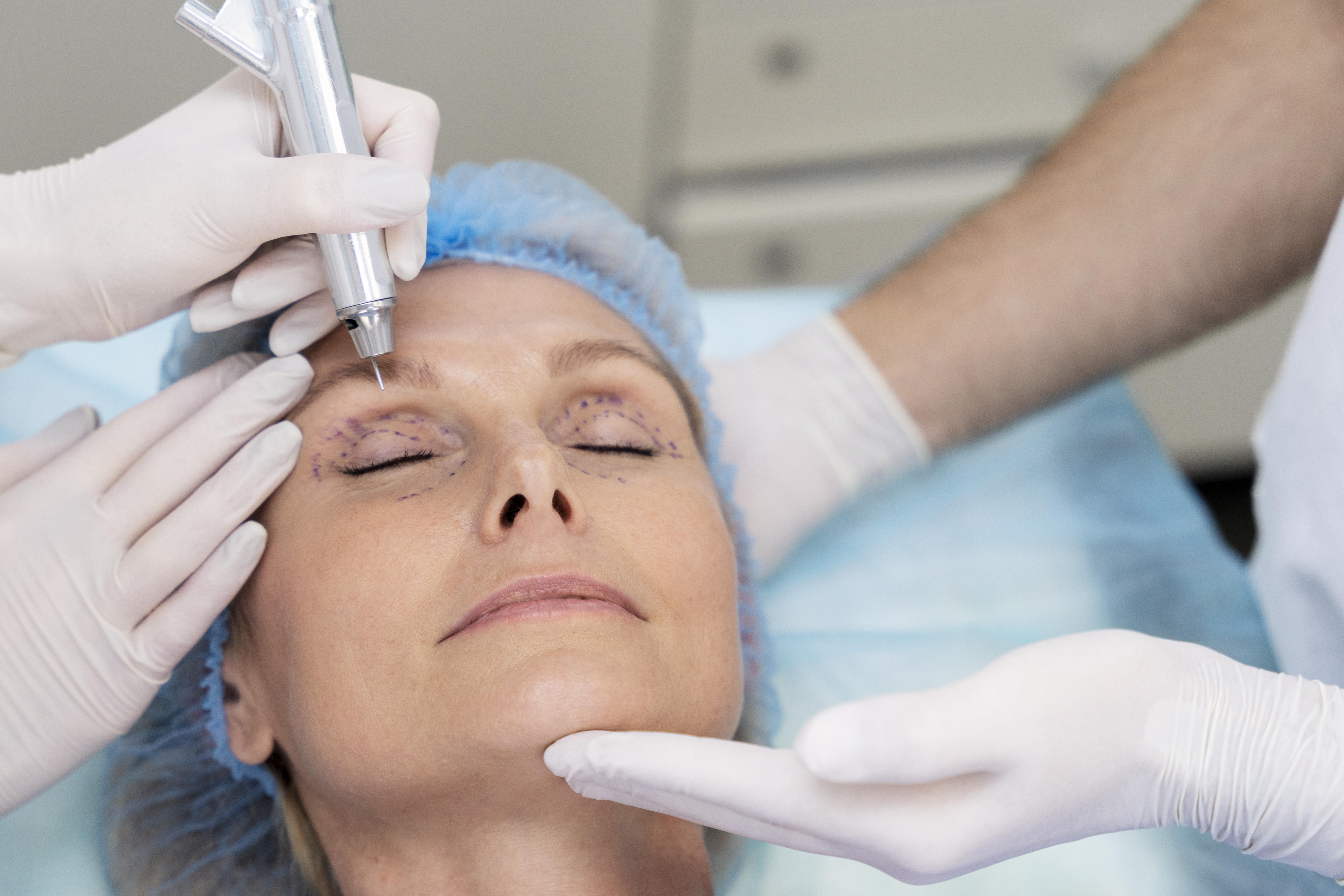 Brow Lift Surgery