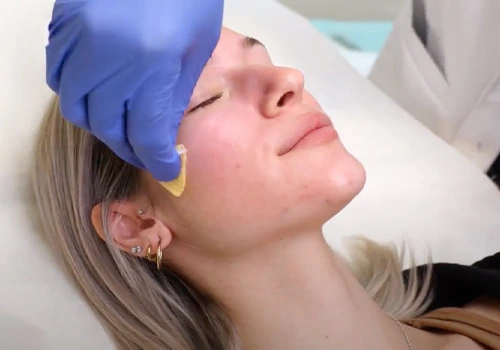 Phenol Chemical Peel Treatment – Robinson Facial Plastic Surgery
